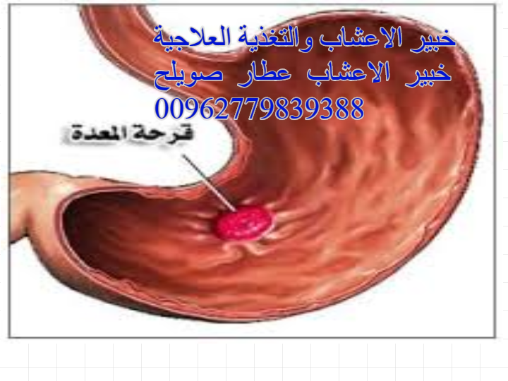 التهاب المعدة المزمن - KibrisPDR